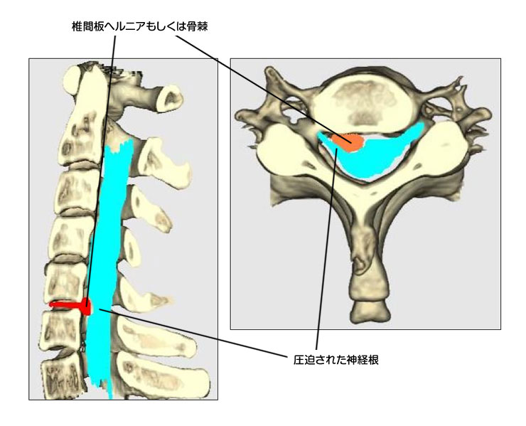 神経 頚椎 根 症 症 完治 性 頚椎症性神経根症・脊髄症の治し方（保存療法と手術）