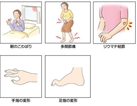 リウマチの代表的な症状