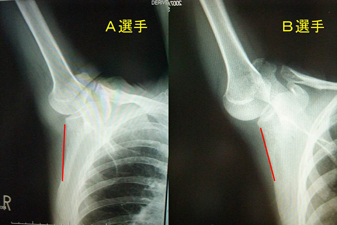 外れ 感じ 肩 た