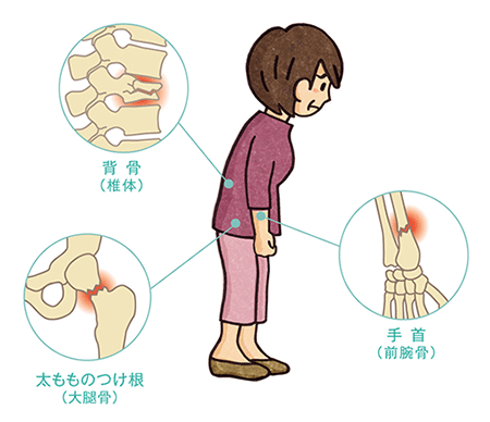 骨粗鬆症について